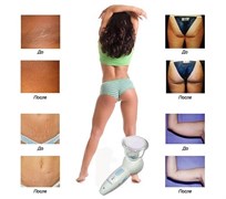 Массажёр Вакуумный "Антицеллюлит" Celluless - фото 25083